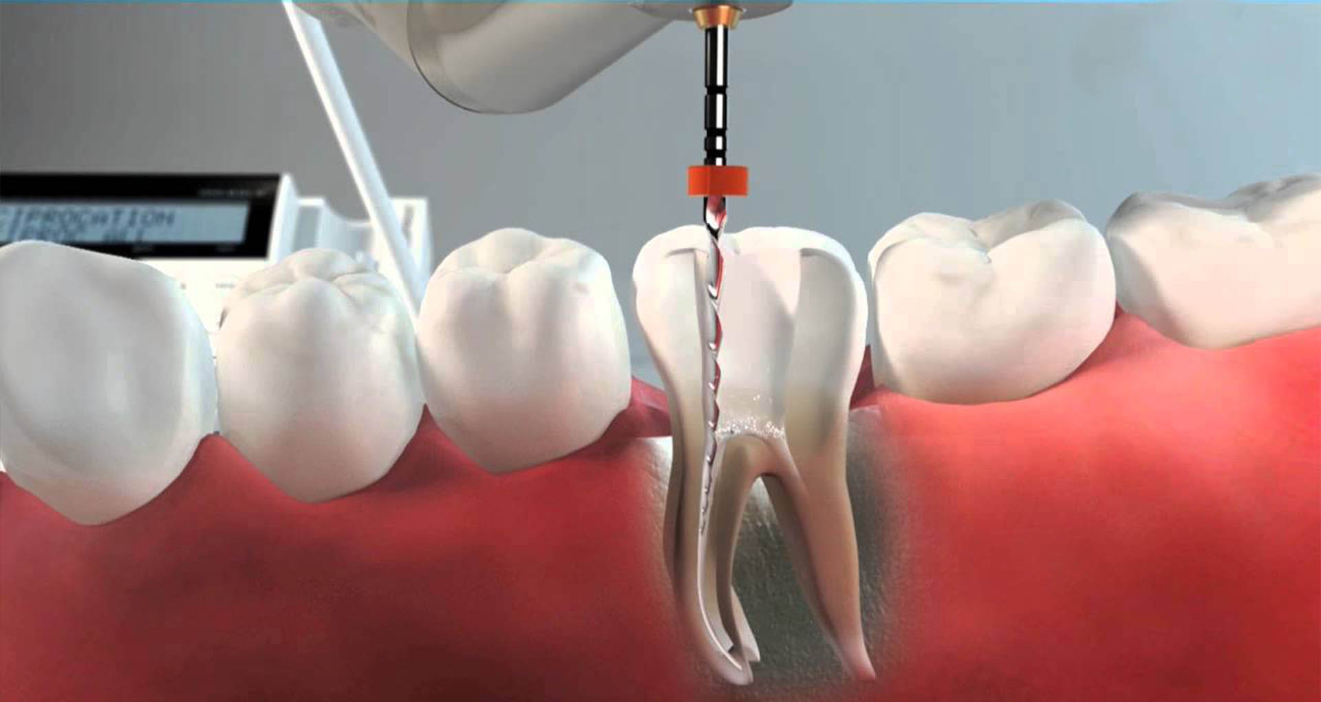 Endodoncia Endodoncia