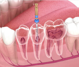 ENDODONCIA
